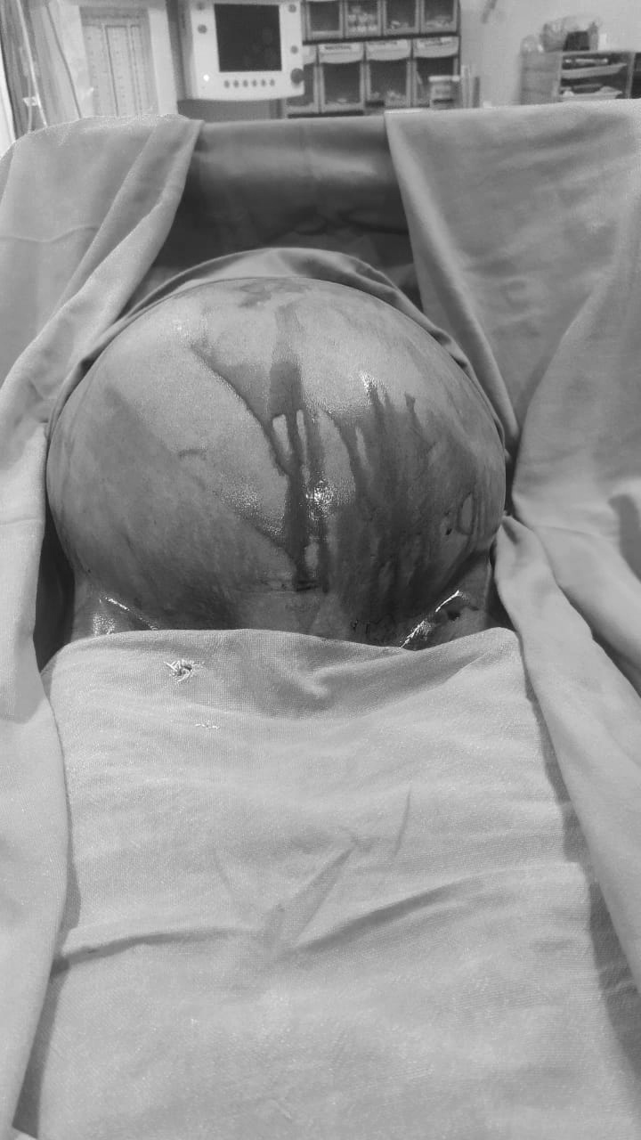 गोदावरी- ११ कि ६० वर्षीया नरपता कामीको पेटबाट ७ किलोको मासुको डल्लो निकालियो