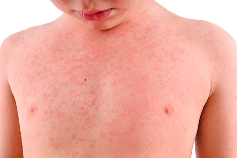 कैलालीको गोदावरी  र गौरीगंगाका २ बालकमा दादुरा संक्रमण